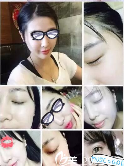 南陽艾美水光注射第七天