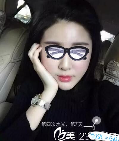 在南陽艾美做了水光注射還一個水嫩嫩的自己