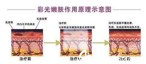 韓國奧拉克皮膚科整外科彩光嫩膚圖 韓國奧拉克皮膚科整外科彩光嫩膚圖
