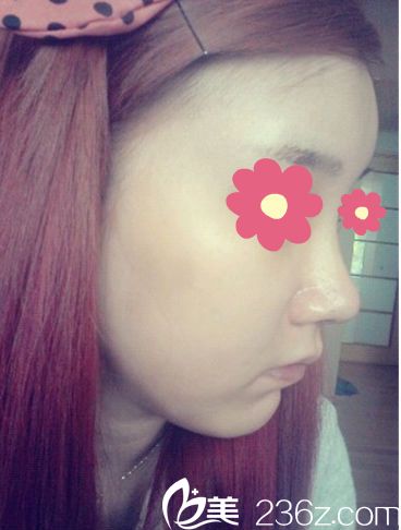 韓國O&YOUNG鼻整形+脂肪移植終于有了喜歡的小臉