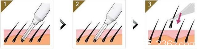 韓國奧拉克皮膚科整外科毛發(fā)移植