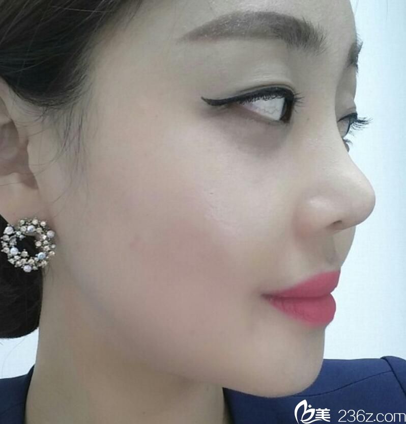 金正培隆鼻<span style=