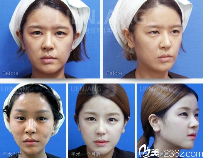 金正培 面部提升