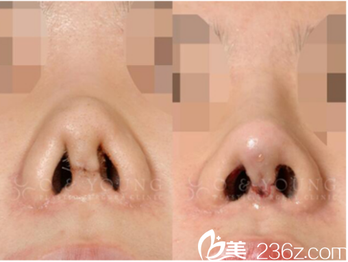 韓國(guó)O&YOUNG整形外科案例