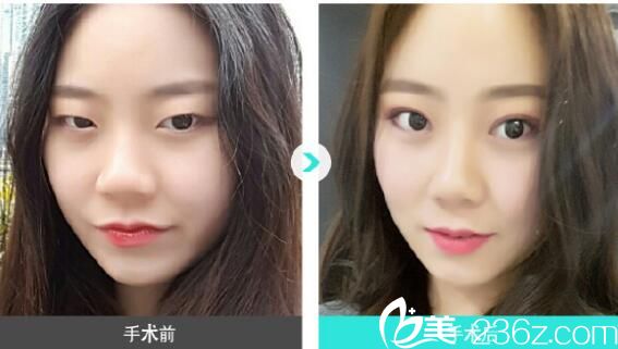 金志桓雙眼皮案例