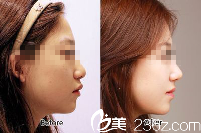 玻尿酸隆鼻前后對比圖