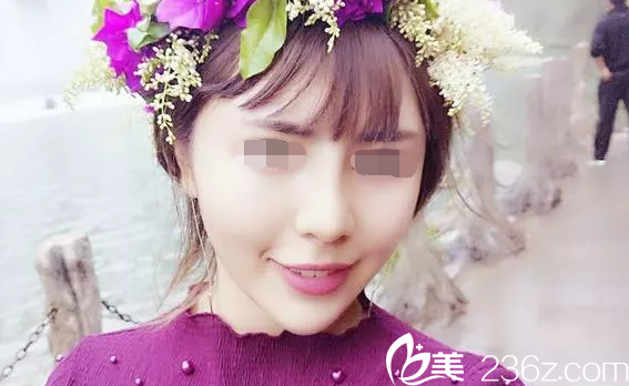 韓國(guó)will醫(yī)院做鼻子術(shù)后兩個(gè)月