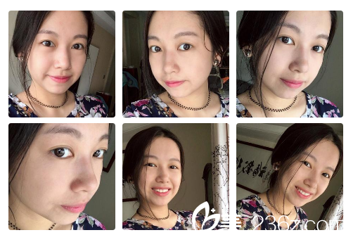 看我找廣州健麗醫(yī)美曹寶濟(jì)院長做的祛眼袋案例效果怎么樣