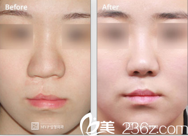 韓國MVP整形外科醫(yī)院案例