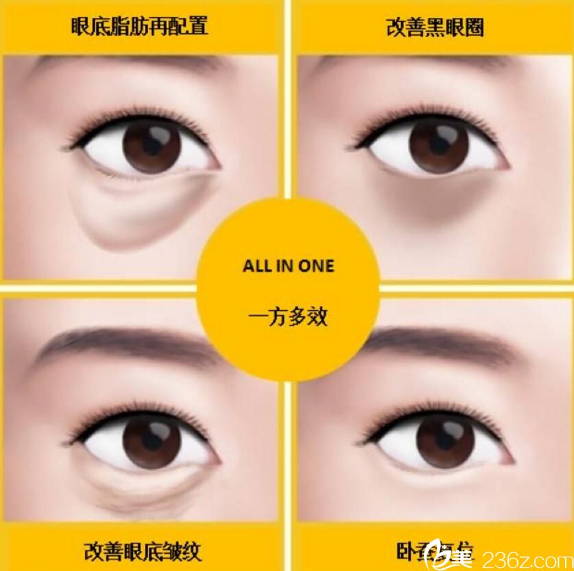 眼底脂肪再配置- 輕松無痕祛除眼袋 眼底脂肪再配置- 輕松無痕祛除眼袋