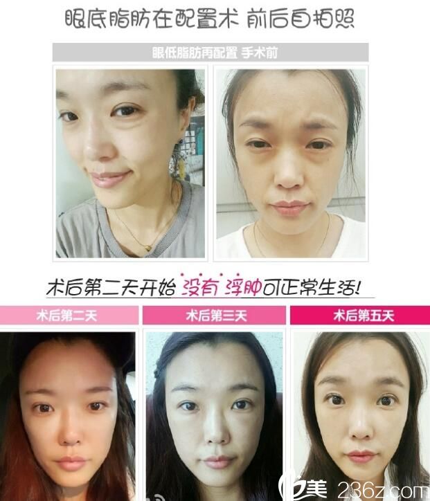 張榮佑眼底脂肪再配置術(shù)案例 張榮佑眼底脂肪再配置術(shù)案例