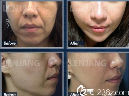 張榮佑院長的oneday提升術(shù)案例 張榮佑院長的oneday提升術(shù)案例