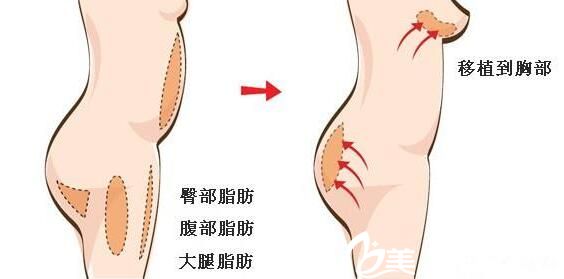 韓國PROPOSE整形醫(yī)院自體脂肪隆胸