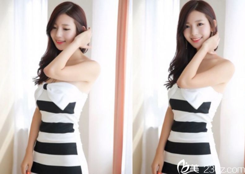 麗延長(zhǎng)張榮佑院長(zhǎng)玻尿酸填充+輪廓針效果我給瘋狂打call