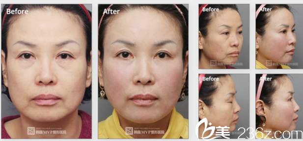 韓國(guó)MVP整形外科醫(yī)院案例