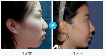 韓國MIGO整形外科醫(yī)院案例 韓國MIGO整形外科醫(yī)院案例