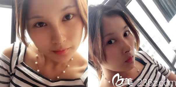 鼻綜合整形手術(shù)第14天恢復圖 鼻綜合整形手術(shù)第14天恢復圖