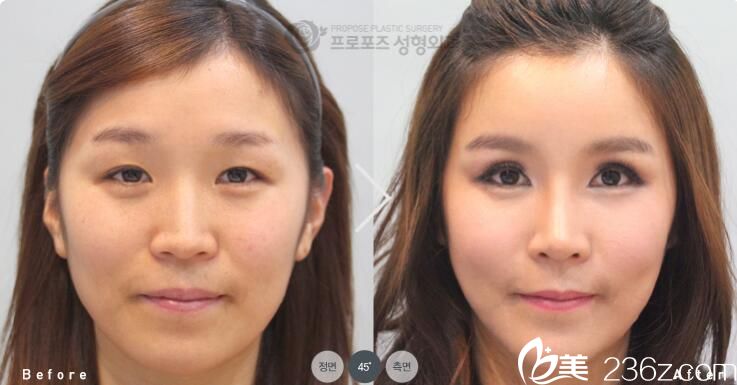 韓國PROPOSE整形醫(yī)院真人案例2