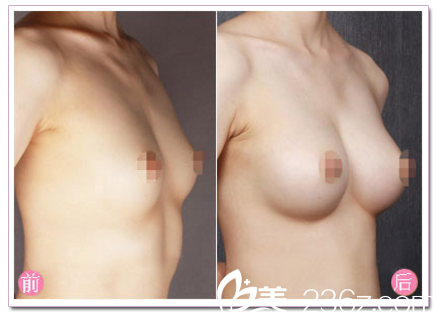 中山美南華整形醫(yī)院<!--<i data=20240703-sp></i>-->隆胸案例 中山美南華整形醫(yī)院<!--<i data=20240703-sp></i>-->隆胸案例