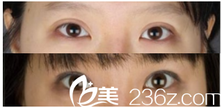 韓國MVP整形雙眼皮修復(fù)怎么樣？過寬多錢？玄炅倍院長案例