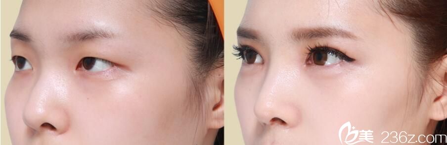 韓國佳輪韓整形外科樸魯爀真人案例3