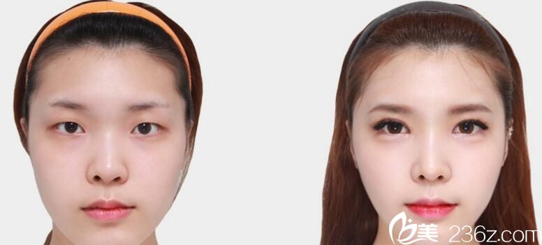 韓國佳輪韓整形外科樸魯爀做鼻子好不好？鷹鉤鼻矯正真人案例