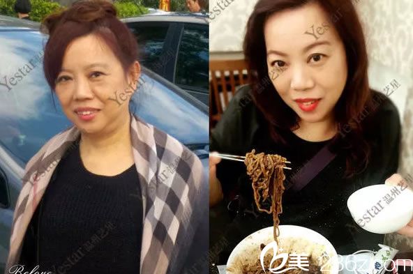 溫州藝星做玻尿酸填充<span style= 溫州藝星做玻尿酸填充<span style=