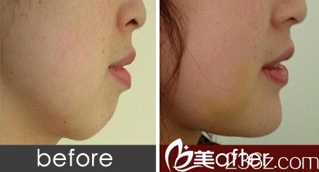 431假體豐下巴前后對(duì)比圖