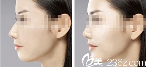 431玻尿酸豐下巴前后對(duì)比圖