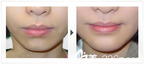 431自體脂肪豐下巴前后對(duì)比圖