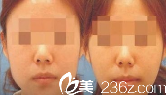 韓國ITEM(愛婷)整形醫(yī)院案例 韓國ITEM(愛婷)整形醫(yī)院案例