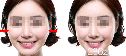 韓國UcanB整形外科醫(yī)院院長金駿昊對顴骨手術(shù)的講解2 韓國UcanB整形外科醫(yī)院院長金駿昊對顴骨手術(shù)的講解2