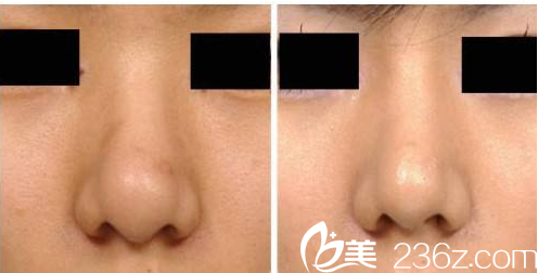 韓國ITEM(愛婷)整形醫(yī)院案例 韓國ITEM(愛婷)整形醫(yī)院案例