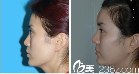 韓國樸宰佑整形外科美容醫(yī)院自體脂肪移植案例 韓國樸宰佑整形外科美容醫(yī)院自體脂肪移植案例