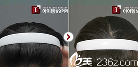 韓國ITEM(愛婷)整形醫(yī)院案例 韓國ITEM(愛婷)整形醫(yī)院案例