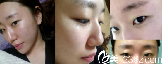 韓國貝緹萊茵醫(yī)院隆鼻和割雙眼皮真人案例1 韓國貝緹萊茵醫(yī)院隆鼻和割雙眼皮真人案例1