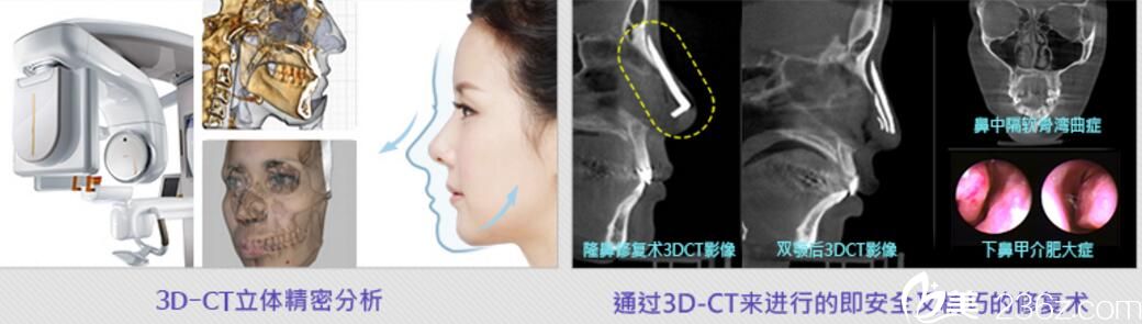 利用3D-CT完成雙鄂手術(shù)后的鼻整形、突嘴整形