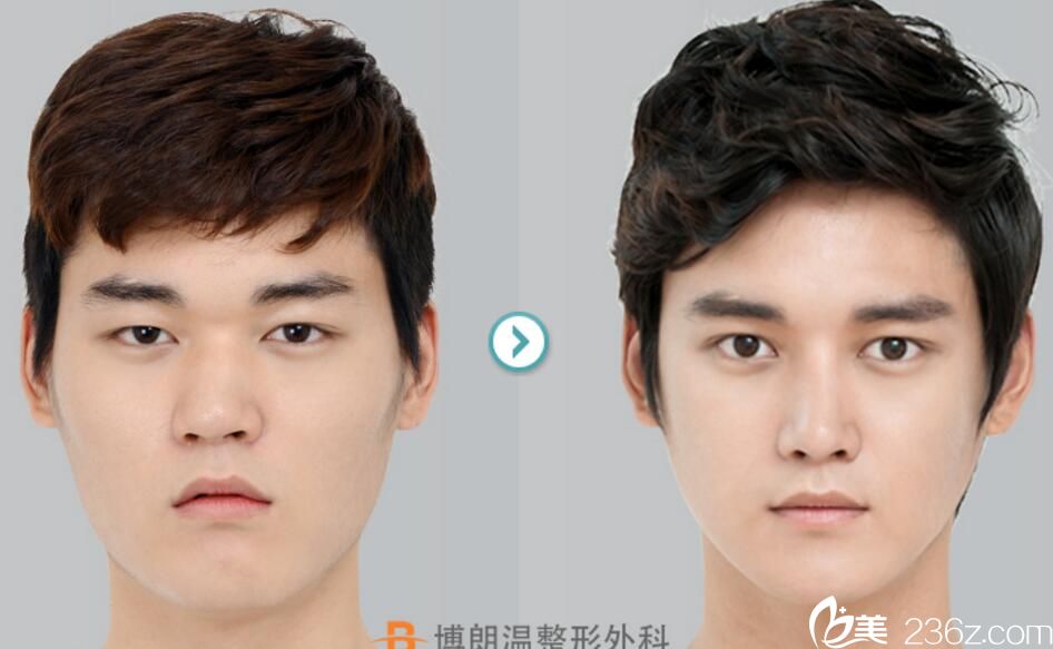 金貴洛院長鼻整形案例