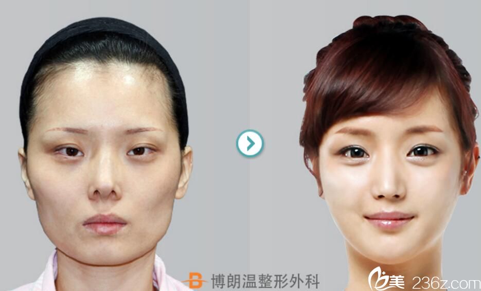 金貴洛院長鼻修復(fù)案例