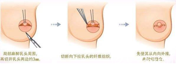 韓國MD胸部整形醫(yī)院宣傳圖 韓國MD胸部整形醫(yī)院宣傳圖