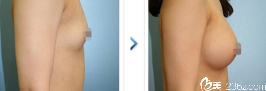 韓國(guó)REX整形外科鄭載勛隆胸效果好不好？硅膠隆胸真人案例