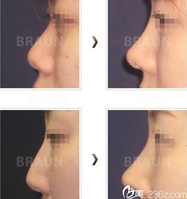 樸光珉鼻整形案例 樸光珉鼻整形案例