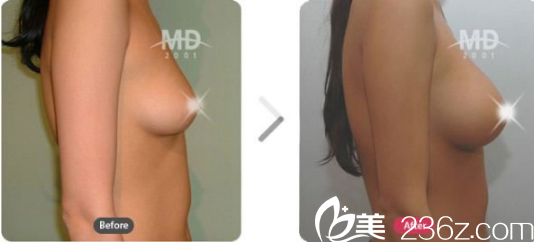 韓國MD胸部整形醫(yī)院案例 韓國MD胸部整形醫(yī)院案例