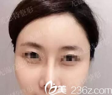 隆鼻失敗鼻型太假案例 隆鼻失敗鼻型太假案例