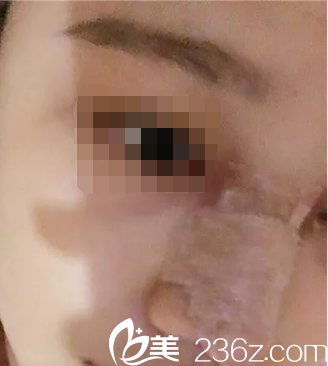 韓國ITEM(愛婷)整形醫(yī)院案例 韓國ITEM(愛婷)整形醫(yī)院案例