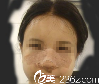 韓國ITEM(愛婷)整形醫(yī)院案例 韓國ITEM(愛婷)整形醫(yī)院案例