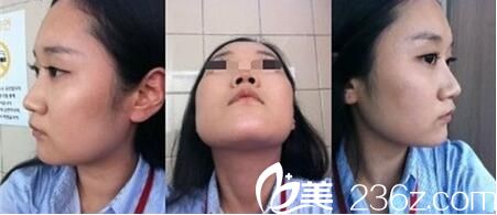 韓國Romian路美顏整形醫(yī)院真人案例圖1 韓國Romian路美顏整形醫(yī)院真人案例圖1