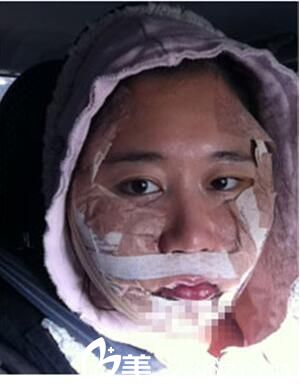 韓國Romian路美顏整形醫(yī)院真人案例圖2 韓國Romian路美顏整形醫(yī)院真人案例圖2