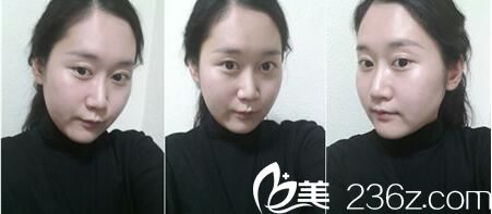 韓國Romian路美顏整形醫(yī)院真人案例圖4 韓國Romian路美顏整形醫(yī)院真人案例圖4