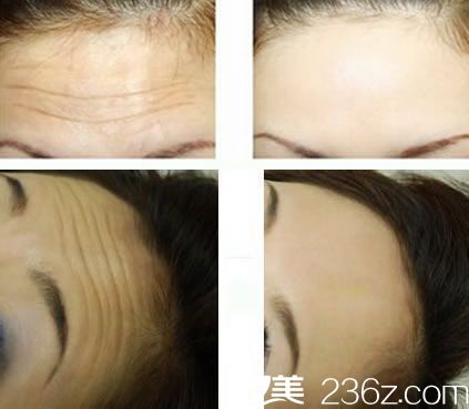 杭州藝星吳云注射玻尿酸祛抬頭紋<span style= 杭州藝星吳云注射玻尿酸祛抬頭紋<span style=